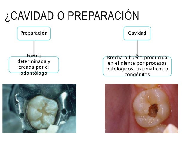 Preparación de cavidades operatoria