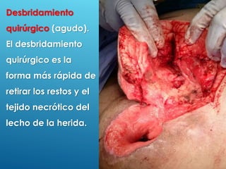 31
Desbridamiento
quirúrgico (agudo).
El desbridamiento
quirúrgico es la
forma más rápida de
retirar los restos y el
tejido necrótico del
lecho de la herida.
 