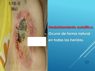 33
Desbridamiento autolítico.
Ocurre de forma natural
en todas las heridas.
 