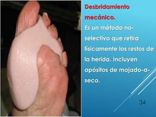 34
Desbridamiento
mecánico.
Es un método no-
selectivo que retira
físicamente los restos de
la herida. Incluyen
apósitos de mojado-a-
seco.
 