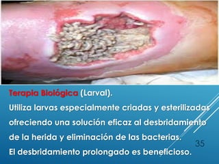 35
Terapia Biológica (Larval).
Utiliza larvas especialmente criadas y esterilizadas
ofreciendo una solución eficaz al desbridamiento
de la herida y eliminación de las bacterias.
El desbridamiento prolongado es beneficioso.
 