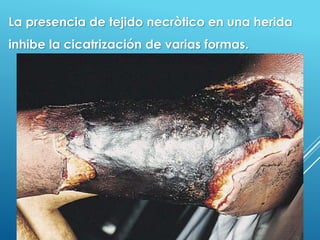 36
La presencia de tejido necròtico en una herida
inhibe la cicatrización de varias formas.
 