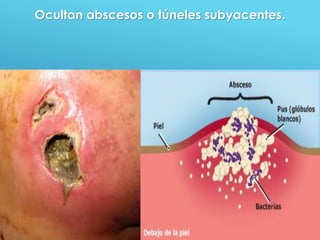 39
Ocultan abscesos o túneles subyacentes.
 