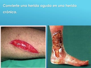 40
Convierte una herida aguda en una herida
crónica.
 