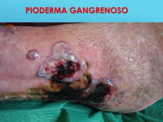44
PIODERMA GANGRENOSO
 