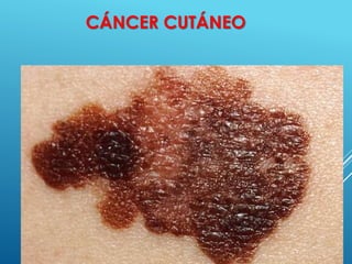 45
CÁNCER CUTÁNEO
 