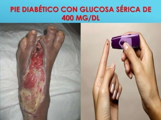 46
PIE DIABÉTICO CON GLUCOSA SÉRICA DE
400 MG/DL
 