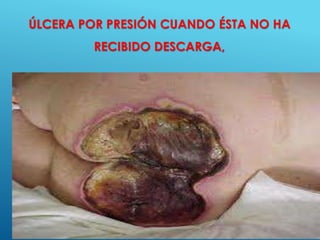 47
ÚLCERA POR PRESIÓN CUANDO ÉSTA NO HA
RECIBIDO DESCARGA,
 