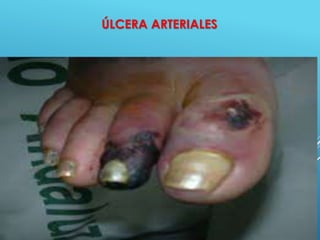 48
ÚLCERA ARTERIALES
 