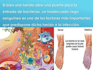 52
Si bien una herida abre una puerta para la
entrada de bacterias, un inadecuado riego
sanguíneo es uno de los factores más importantes
que predispone dicha herida a la infección.
 