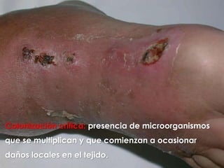 57
Colonización crítica: presencia de microorganismos
que se multiplican y que comienzan a ocasionar
daños locales en el tejido.
 