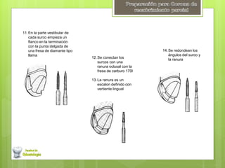 11.En la parte vestibular de
cada surco empieza un
flanco en la terminación
con la punta delgada de
una fresa de diamante tipo
llama
12.Se conectan los
surcos con una
ranura oclusal con la
fresa de carburo 170l
13.La ranura es un
escalon definido con
vertiente lingual
14.Se redondean los
ángulos del surco y
la ranura
 