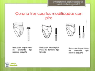 Corona tres cuartos modificadas con
pins
Reducción lingual: fresa
de diamante tipo
redonda pequeña
Reducción axial lingual:
fresa de diamante tipo
torpedo
Reducción lingual: fresa
de diamante tipo
redonda pequeña
 