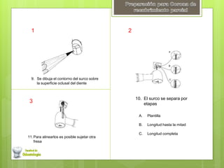 9. Se dibuja el contorno del surco sobre 
la superficie oclusal del diente 
10. El surco se separa por 
etapas 
11.Para alinearlos es posible sujetar otra 
fresa 
A. Plantilla 
B. Longitud hasta la mitad 
C. Longitud completa 
1 2 
3 
 
