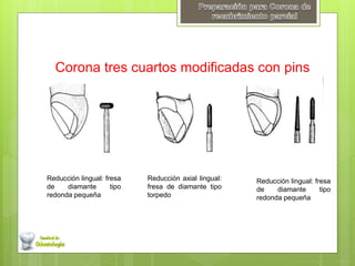 Corona tres cuartos modificadas con pins 
Reducción lingual: fresa 
de diamante tipo 
redonda pequeña 
Reducción axial lingual: 
fresa de diamante tipo 
torpedo 
Reducción lingual: fresa 
de diamante tipo 
redonda pequeña 
 