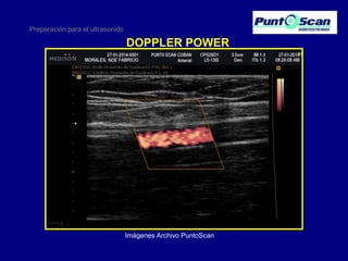 Preparación para el ultrasonido

DOPPLER POWER

Imágenes Archivo PuntoScan

 