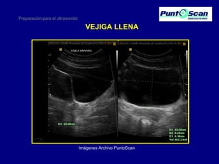 Preparación para el ultrasonido

VEJIGA LLENA

Imágenes Archivo PuntoScan

 