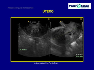 Preparación para el ultrasonido

UTERO

Imágenes Archivo PuntoScan

 