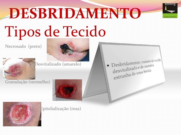 DESBRIDAMENTO DE FERIDAS PDF