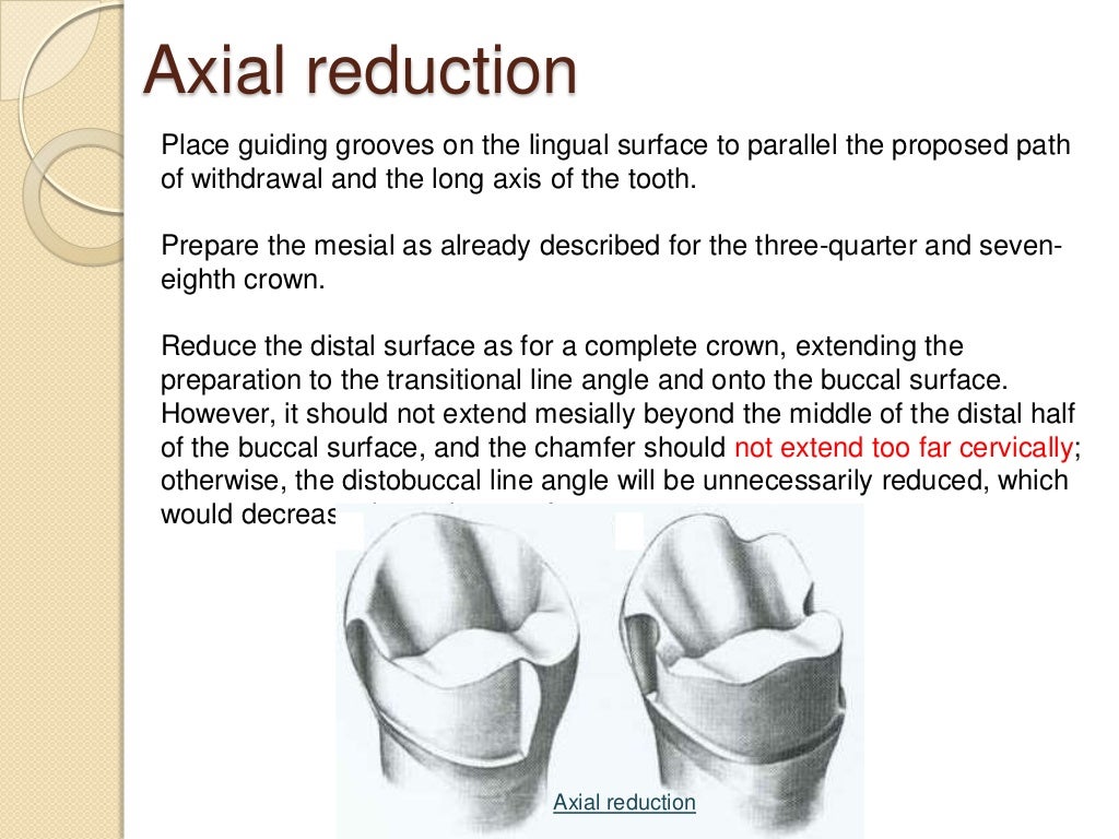 Preparation of partial veneer crown