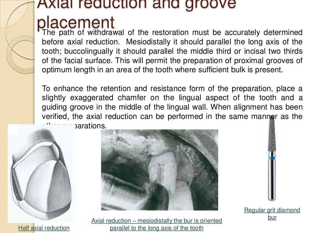 Preparation of partial veneer crown