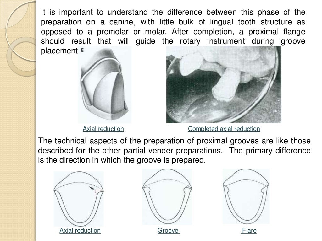 Preparation of partial veneer crown