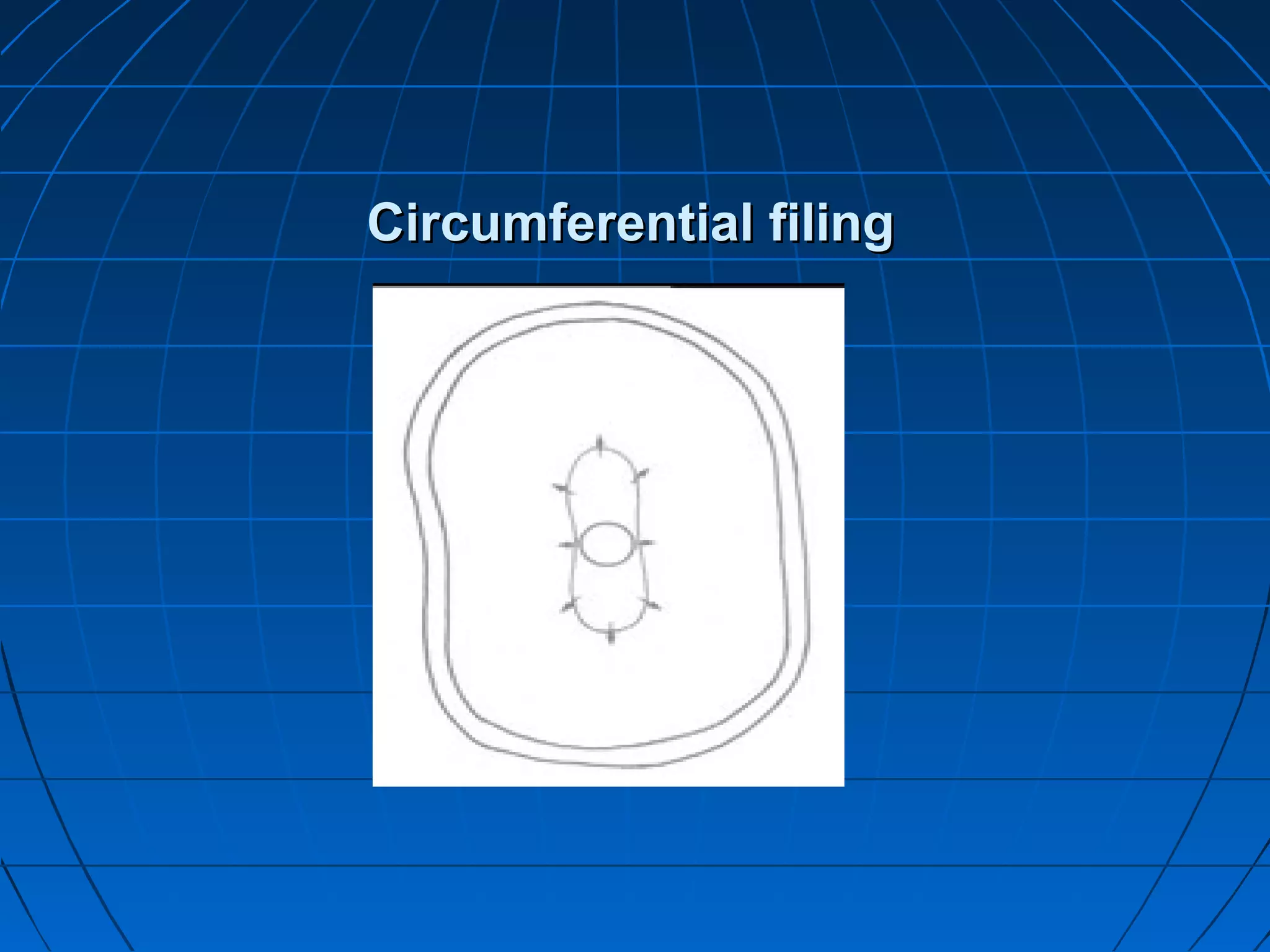 Circumferential filingCircumferential filing
 