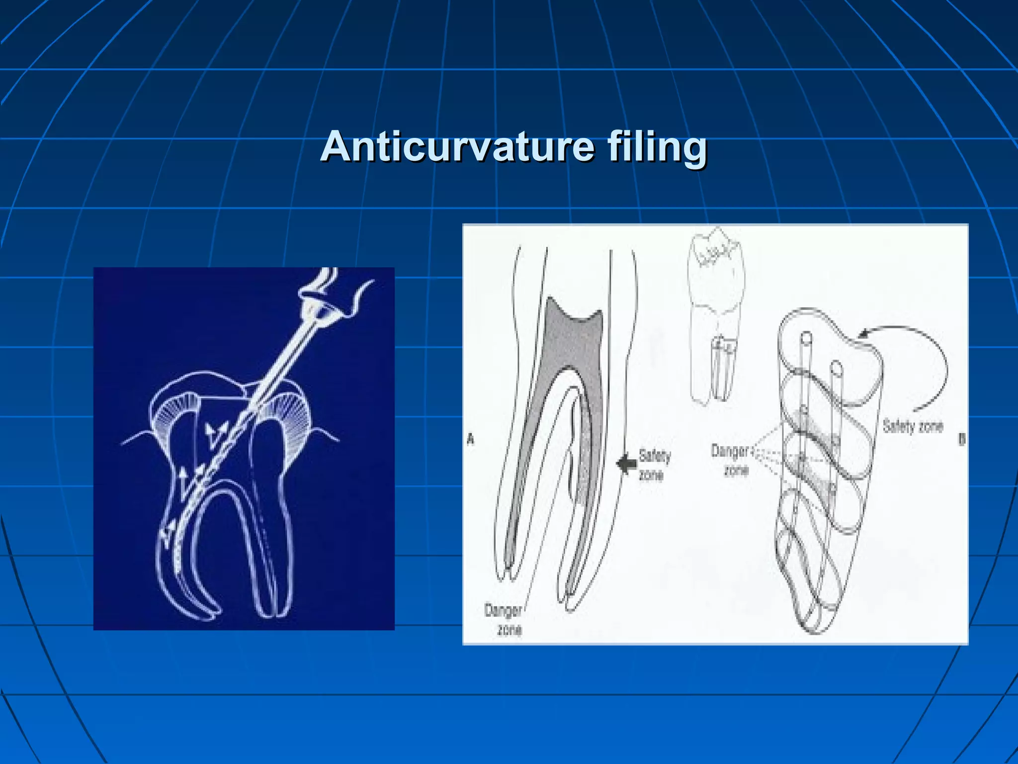 Anticurvature filingAnticurvature filing
 
