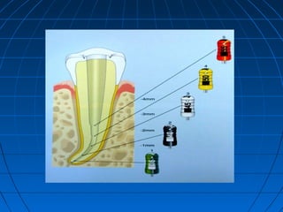 Preparation of the root canal system | PPT