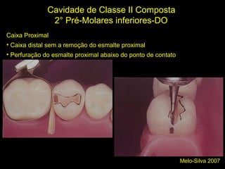 Melo-Silva 2007
Cavidade de Classe II Composta
2° Pré-Molares inferiores-DO
Caixa Proximal
• Caixa distal sem a remoção do esmalte proximal
• Perfuração do esmalte proximal abaixo do ponto de contato
;)
 