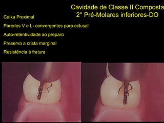 Melo-Silva 2007
Cavidade de Classe II Composta
2° Pré-Molares inferiores-DOCaixa Proximal
Paredes V e L- convergentes para oclusal
Auto-retentividade ao preparo
Preserva a crista marginal
Resistência á fratura
;)
 