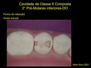Melo-Silva 2007
Cavidade de Classe II Composta
2° Pré-Molares inferiores-DO
Forma de retenção
Caixa oclusal
 