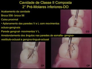 Melo-Silva 2007
Cavidade de Classe II Composta
2° Pré-Molares inferiores-DO
Acabamento da cavidade
Broca 556- broca 56
Caixa proximal
• Aplanamento das paredes V e L com movimentos
ocluso-gengivais
Parede gengival- movimentos V L
Arredondamento dos ângulos nas paredes de esmalte- gengivo-
vestibulo-oclusal e gengivo-lingual-oclusal
CO
CP CP
 