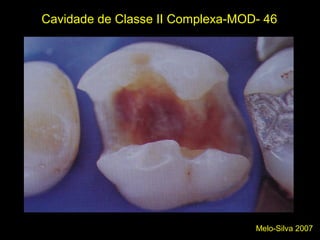 Melo-Silva 2007
Cavidade de Classe II Complexa-MOD- 46
 