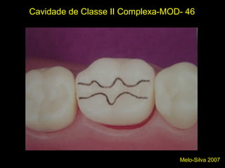 Melo-Silva 2007
Cavidade de Classe II Complexa-MOD- 46
Forma de Contorno
 