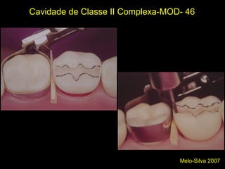 Melo-Silva 2007
Cavidade de Classe II Complexa-MOD- 46
Desgaste da crista marginal
 