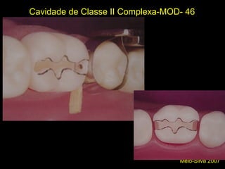 Melo-Silva 2007
Cavidade de Classe II Complexa-MOD- 46
Perfuração da parede de esmalte
 