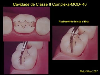 Melo-Silva 2007
Cavidade de Classe II Complexa-MOD- 46
Paredes da caixa proximal VLGA
Acabamento inicial e final
 
