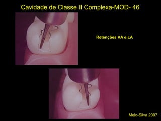 Melo-Silva 2007
Cavidade de Classe II Complexa-MOD- 46
Retenções VA e LA
 