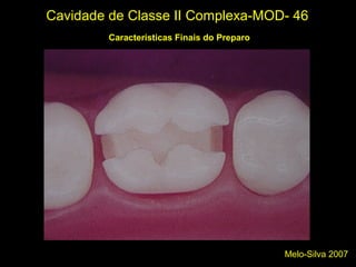 Melo-Silva 2007
Cavidade de Classe II Complexa-MOD- 46
Características Finais do Preparo
 