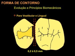 Melo-Silva 2007
Evolução e Princípios Biomecânicos
FORMA DE CONTORNO
 Para Vestibular e Lingual
0,2 à 0,5 mm
 
