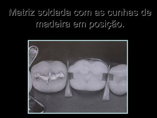 Matriz soldada com as cunhas deMatriz soldada com as cunhas de
madeira em posição.madeira em posição.
 