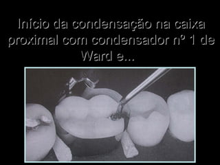 Início da condensação na caixaInício da condensação na caixa
proximal com condensador nº 1 deproximal com condensador nº 1 de
Ward e...Ward e...
 