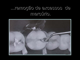 ...remoção de excessos de...remoção de excessos de
mercúrio.mercúrio.
 