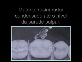 Material restauradorMaterial restaurador
condensado até o nívelcondensado até o nível
da parede pulpar.da parede pulpar.
 