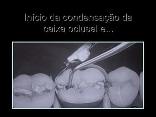 Início da condensação daInício da condensação da
caixa oclusal e...caixa oclusal e...
 