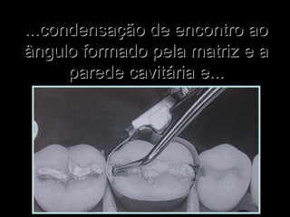 ...condensação de encontro ao...condensação de encontro ao
ângulo formado pela matriz e aângulo formado pela matriz e a
parede cavitária e...parede cavitária e...
 