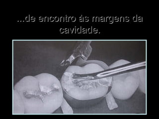 ...de encontro às margens da...de encontro às margens da
cavidade.cavidade.
 