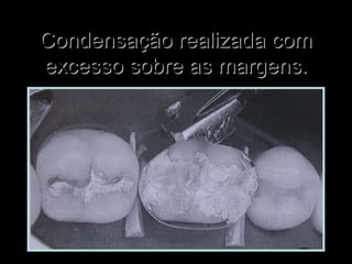 Condensação realizada comCondensação realizada com
excesso sobre as margens.excesso sobre as margens.
 