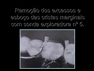 Remoção dos excessos eRemoção dos excessos e
esboço das cristas marginaisesboço das cristas marginais
com sonda exploradora nº 5.com sonda exploradora nº 5.
 